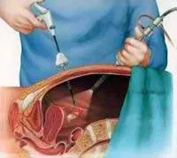 Ендоскопічні гінекологічні операції в москві (москві) Ендоскопічні гінекологічні операції в москві