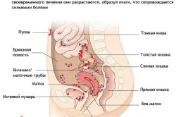 Ендометріоз матки симптоми і лікування (лікування) Ендометріоз матки симптоми і лікування
