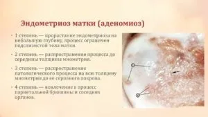 Ендометріоз матки його причини, симптоми, діагностика, лікування
