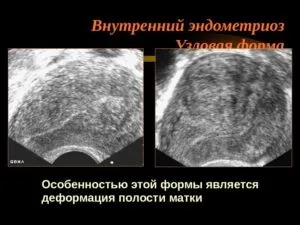 Ендометріоз матки його причини, симптоми, діагностика, лікування
