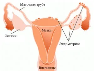 Ендометріоз матки його причини, симптоми, діагностика, лікування