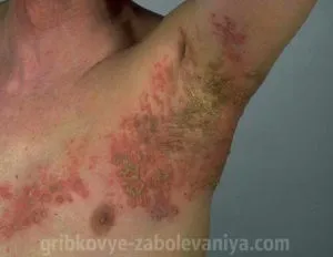 Еритразма причини, симптоми, лікування, профілактика (еритразма) Еритразма причини, симптоми, лікування, профілактика