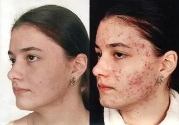 Еритразма лікування народними засобами