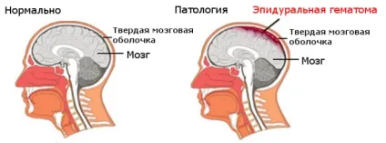 Епідуральна гематома головного мозку симптоми і лікування (мозку) Епідуральна гематома головного мозку симптоми і лікування