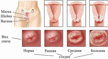 Ерозія шийки матки, фото що це таке і як лікувати (матки) Ерозія шийки матки, фото що це таке і як лікувати