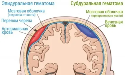 Епідуральна гематома головного мозку причини, симптоми, лікування, наслідки (мозку) Епідуральна гематома головного мозку причини, симптоми, лікування, наслідки