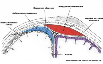 Епідуральна гематома головного мозку (головного) Епідуральна гематома головного мозку