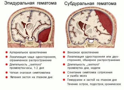 Епідуральна гематома головного мозку наслідки, лікування, симптоми (гематома) Епідуральна гематома головного мозку наслідки, лікування, симптоми