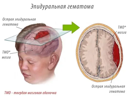 Епідуральна гематома - етіологія, методи діагностики і лікування (методи) Епідуральна гематома - етіологія, методи діагностики і лікування