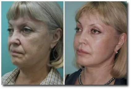 Філлери в вилиці для корекції овалу обличчя фото до і після, гіалуронова кислота (після) Філлери в вилиці для корекції овалу обличчя фото до і після, гіалуронова кислота
