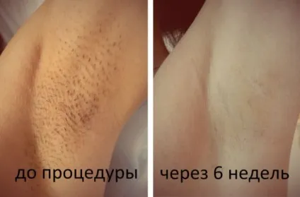 Фотоепіляція відгуки, фото до і після (фотоепіляція) Фотоепіляція відгуки, фото до і після