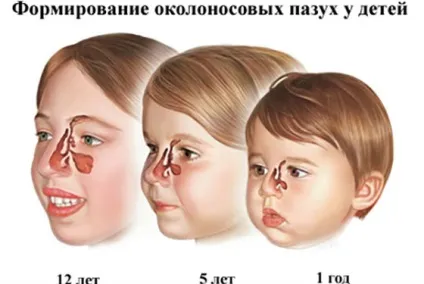 Гайморит у дітей види, симптоми, лікування, ускладнення, як діагностують, причини і профілактика (лікування) Гайморит у дітей види, симптоми, лікування, ускладнення, як діагностують, причини і профілактика