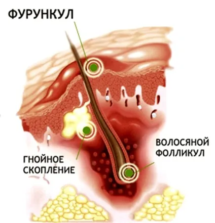 Фурункул у вусі - симптоми чірья, нариву і гнійника (нариву) Фурункул у вусі - симптоми чірья, нариву і гнійника