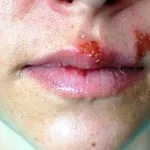 Герпес на шкірі тіла і обличчя симптоми і лікування (шкірі) Герпес на шкірі тіла і обличчя симптоми і лікування