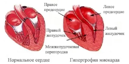 Гіпертрофія правого передсердя причини, лікування і наслідки