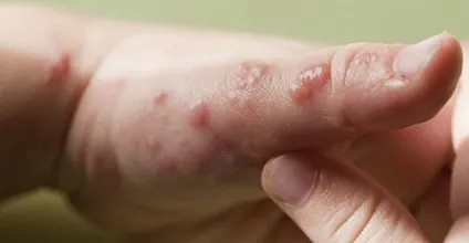 Герпес на руках симптоми і лікування між пальцями в домашніх умовах (пальцями) Герпес на руках симптоми і лікування між пальцями в домашніх умовах