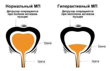 Гіперактивний сечовий міхур діагностика, лікування, особливості (міхур) Гіперактивний сечовий міхур діагностика, лікування, особливості