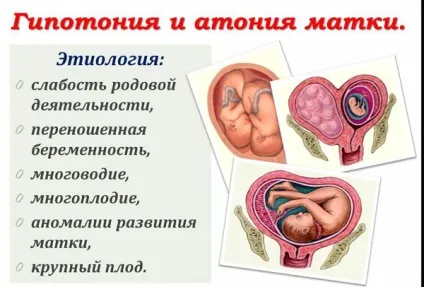 Гіпотонія матки після пологів - що це таке, причини, симптоми, при кесаревому розтині, при
