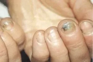 Грибок до під нігтями на руках і ногах - зовнішній вигляд симптоми, лікування (нігтями) Грибок до під нігтями на руках і ногах - зовнішній вигляд симптоми, лікування