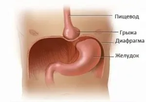 Грижа шлунка симптоми і причини