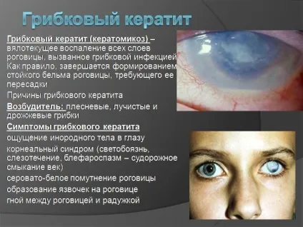 Грибковий кератит - причини, симптоми і лікування (фото) (причини) Грибковий кератит - причини, симптоми і лікування (фото)