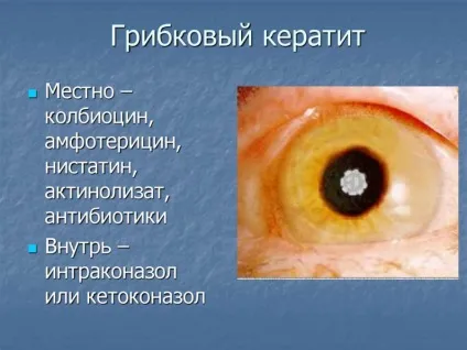 Грибковий кератит - причини, симптоми і лікування (фото) (симптоми) Грибковий кератит - причини, симптоми і лікування (фото)