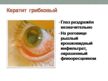 Грибковий кератит - причини, симптоми і лікування (фото) (грибковий) Грибковий кератит - причини, симптоми і лікування (фото)