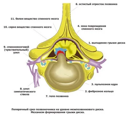 Грижа хребта операція, наслідки (операція) Грижа хребта операція, наслідки