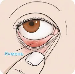 Як швидко вилікувати ячмінь на оці будинки за 1 день вибираємо препарати і народні засоби (оці) Як швидко вилікувати ячмінь на оці будинки за 1 день вибираємо препарати і народні засоби