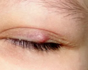 Як швидко вилікувати ячмінь на оці будинки за 1 день вибираємо препарати і народні засоби (вилікувати) Як швидко вилікувати ячмінь на оці будинки за 1 день вибираємо препарати і народні засоби