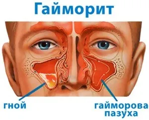 Як позбутися від хронічного гаймориту