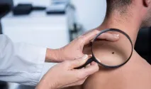 Вірус папіломи людини ВПЛ 33 типу як діє, діагностика та лікування у жінок та чоловіків папіломи