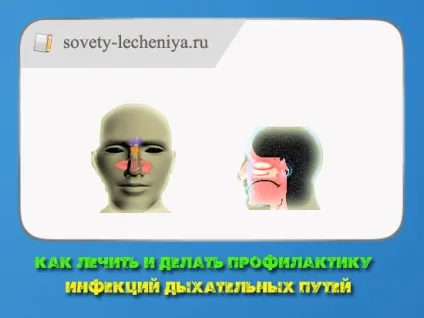 Як лікувати і робити профілактику інфекцій дихальних шляхів