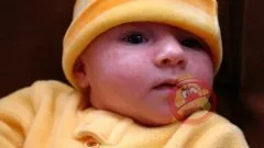 Як відрізнити алергію від цвітіння - алергія дитяча