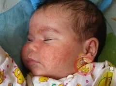 Як відрізнити алергію від цвітіння - алергія дитяча