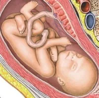 Malnutriția intrauterină, ca întârziere în dezvoltarea fătului