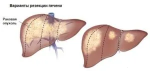 Як виглядають метастази в печінці на узі, що робити (печінки) Як виглядають метастази в печінці на узі, що робити