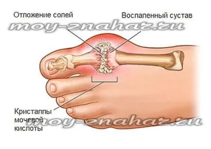 Як вивести солі і сечову кислоту з суглобів народними засобами (з) Як вивести солі і сечову кислоту з суглобів народними засобами