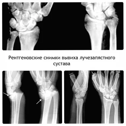 Як вчасно визначити вивих кисті руки і вилікувати (вивих кисті руки) Як вчасно визначити вивих кисті руки і вилікувати