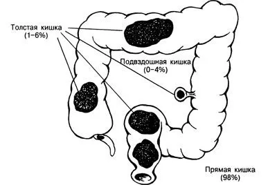 Калових пробка в кишечнику що робити, як позбутися