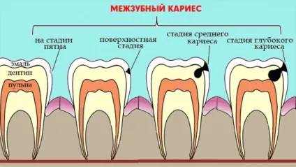 Карієс між передніми зубами особливості, методи лікування (карієс між передніми зубами фото) Карієс між передніми зубами особливості, методи лікування