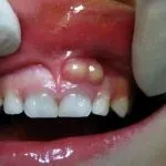 Кіста зуба що це таке, симптоми і методи лікування