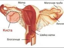 Кіста яєчника і вагітність (яєчника) Кіста яєчника і вагітність