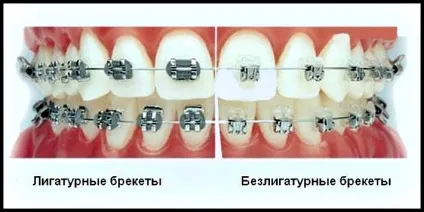 Керамічні брекет-системи види, установка, фото і особливості брекетів (установка) Керамічні брекет-системи види, установка, фото і особливості брекетів