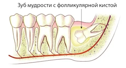 Кіста зуба що це таке, симптоми і методи лікування