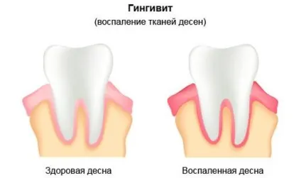 Кислий присмак у роті причини, лікування, як позбутися (присмак) Кислий присмак у роті причини, лікування, як позбутися