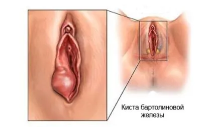 Кіста бартолінової залози, лікування без операції, народними засобами (запалення) Кіста бартолінової залози, лікування без операції, народними засобами