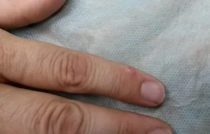 Кіста на пальці руки - фото, відео, опис симптоматики (фото) Кіста на пальці руки - фото, відео, опис симптоматики