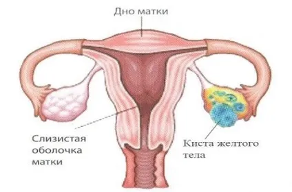 Кіста жовтого тіла причини, симптоми, ускладнення, лікування (жовтого) Кіста жовтого тіла причини, симптоми, ускладнення, лікування