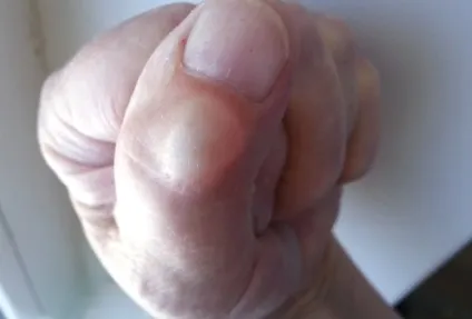 Кіста на пальці руки - фото, відео, опис симптоматики (руки) Кіста на пальці руки - фото, відео, опис симптоматики
